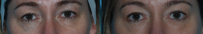 35-44 year old woman treated with AccuTite - Patient was unhappy with her under eyes, felt she looked tired. Patient is seen here one month after one Accutite treatment with a more youthful and refreshed look.