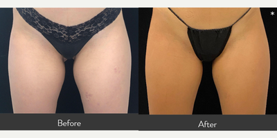 35-44 year old woman treated with CoolSculpting Elite - Our 38 yr old female patient had 1 CoolSculpting Elite session to her inner thighs. She is shown before and only 6 weeks after treatment.
