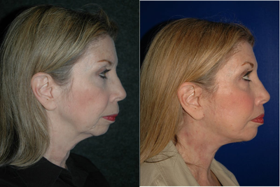 Lip Repositioning - Lip Lift + Chin Implant + Deep Plane Facelift
