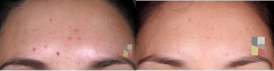 25-34 year old woman treated with LED & Light Skin Peels - Before and after light skin peels and LED for acne and congestion by Procedural Nurse Tara Coetzer