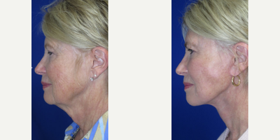 Woman treated with Nonsurgical Facelift, Nonsurgical Neck Lift - Check out this beautiful patient who came to us seeking #FacialRejuvenation to address her sagging jowls, drooping skin in her neck, and deep wrinkles around her mouth. Swipe to see results.