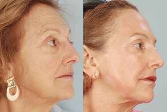Pearl Laser Resurfacing - Pearl Laser Resurfacing