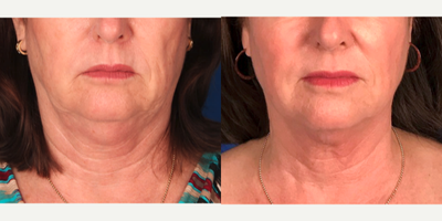 55-64 year old woman treated with Profound RF - One Profound Rf treatment, supplemented with one Excel V treatment for post-op bruising and 2 Sublative RF treatments to smooth fine lines and wrinkles.
