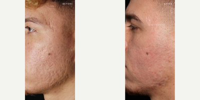 Acne Scars combination Treatment by Dr. Qazi - This patient did a combination treatment with Subcision and CO2 Laser to get rid of his acne scars.