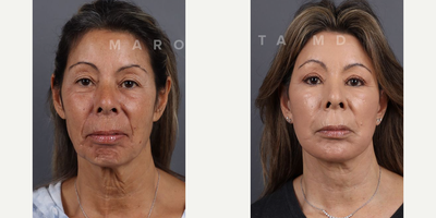 Woman treated with Skin Rejuvenation, Deep Plane Facelift, Neck Lift - Facial rejuvenation with @drjamesmarotta! Swipe left to witness another incredible before and after journey. Dr. Marotta's expertise shines through in these great results, achieved through a combination of deep plane face and neck lift, upper blepharoplasty, perioral dermabrasion, and a chemical peel.Deep Plane Face and Neck Lift: Elevate your beauty to new heights as Dr. Marotta reshapes and rejuvenates facial contours by addressing deeper layers, tackling sagging skin and restoring youthful volume.Upper Blepharoplasty: Open your eyes to a brighter, more refreshed look! Dr. Marotta's precise upper blepharoplasty technique removes excess skin, revealing the true beauty of your gaze.Perioral Dermabrasion: Erase the traces of time around your mouth with perioral dermabrasion. Experience smoother, radiant skin as fine lines and wrinkles fade away.Chemical Peel Magic: Peel back the years with a chemical peel curated by Dr. Marotta. Unveil a radiant complexion, free from imperfections, as the outer layers of your skin are renewed.