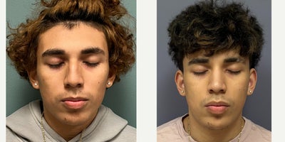 18-24 year old man treated with Septoplasty, Rhinoplasty - This is a young man who underwent septorhinoplasty.