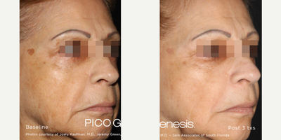 55-64 year old woman treated with Laser Genesis - PICO Genesis is a novel treatment that can improve the appearance of acne scars, diminish pigmented lesions, reduce fine lines and wrinkles, and shrink enlarged pores, improve texture, tone and pigmentation concerns. After 3 treatments