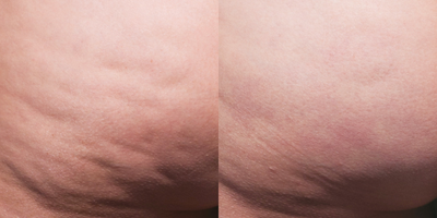 35-44 year old woman treated with Cellfina - Cellfina