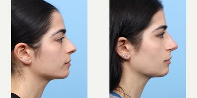 25-34 year old woman treated with Nonsurgical Nose Job, Voluma, Dysport - This patient wanted to straighten the bridge of her nose, without a permanent commitment. Dr. Wise performed a non-surgical rhinoplasty, injecting the nose with voluma and dysport, to achieve the desired results.
