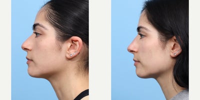 25-34 year old woman treated with Nonsurgical Nose Job, Voluma, Dysport - This patient wanted to straighten the bridge of her nose, without a permanent commitment. Dr. Wise performed a non-surgical rhinoplasty, injecting the nose with voluma and dysport, to achieve the desired results.