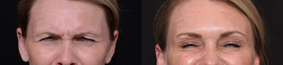 Woman treated with Jeuveau - Woman treated with Jeuveau