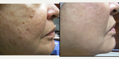 45-54 year old woman treated with Vampire Facial - Prp skin rejuvenation treatment