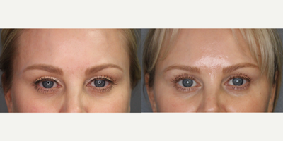 Neocutis Eye Cream for this 43-Year-Old Woman - This 43-year-old woman has been using Neocutis Micro Eyes and Lumire Firm Riche eye cream to improve the appearance of crow's feet, dark circles, and sagging skin around the eye area. She loves the product and the way its transformed her eyes.