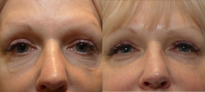58 year old woman treated with Morpheus8 - 58 year old female following 2 Morpheus8 and Fractora treatments of the lower lids.