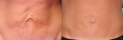 45-54 year old woman treated with Thermage - 3 months after Thermage abdomen