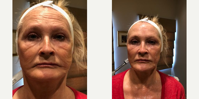 65-74 year old woman treated with Collagen Injection - 65 year old female after one treatment of DEP (dermoelectroporation) with collagen. No down time. Immediate results. Pain free.