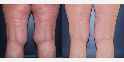  Thigh Lift - 64 year-old woman was concerned with sagging skin on the thighs and excess fat surrounding the knees. She was treated with liposuction around the knees and an inner thigh lift.
