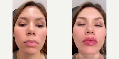 Woman treated with Juvederm - Woman treated with 0.7ml of Juvederm XC as lip fillers