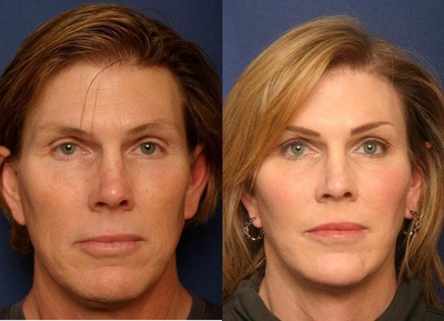 Woman treated with Facial Feminization Surgery - Woman treated with Facial Feminization Surgery