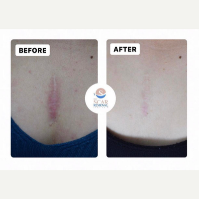 25-34 year old woman treated with Vbeam for Scar Removal - All patients must be evaluated in order to give an estime of sessions needed.