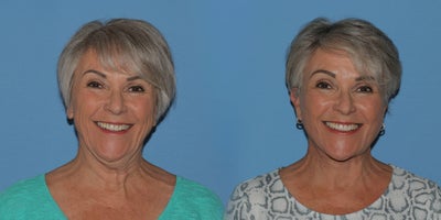 Woman treated with Deep Plane Facelift - Woman treated with Deep Plane Facelift
