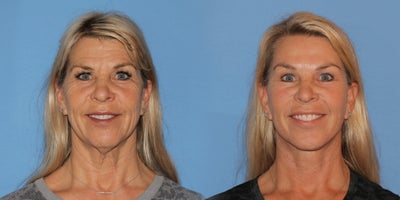 Woman treated with Deep Plane Facelift - Woman treated with Deep Plane Facelift