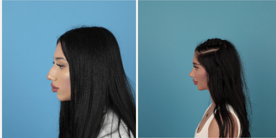 18-24 year old woman treated with Rhinoplasty - Piezo rhinoplasty