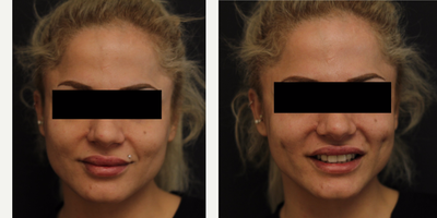 25-34 year old woman treated with Dimpleplasty - 25-34 year old woman treated with Dimpleplasty