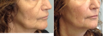 65-74 year old woman treated with Bellafill - Liquid face lift