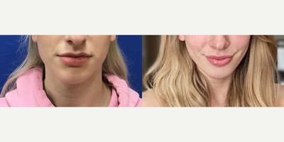 Patient treated with Genioplasty - Chin Reduction and Contour - 18 to 24 year-old female patient is 1 year post-op from Facial Feminization surgery. Her procedures included: Forehead Lift, Hairline Lowering, Orbital Bony Contouring, Septorhinoplasty (closed) with Cartilage Grafts, Radix Graft and Weirs, Cheek Implants (small), Chin Reduction and Contour, Subnasal Lip Lift with Fat Augmentation to Lips, Thyroid Cartilage Shave and 300 Micrografts to Recessions.