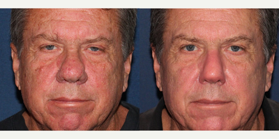 61year old man treated with Photodynamic Therapy - This 61 year old male was treated by Dr. Groff with PDT using q-alex, Vbeam Perfecta, and red and blue light. This is before and after only one treatment. During the same session, Dr. Groff also used a CO2 laser to reshape the rhinophyma on his nose.
