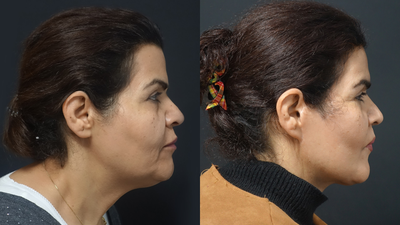40-50 year old woman treated with Facelift - 40-50 year old woman treated with Facelift - 12Months Post-operative