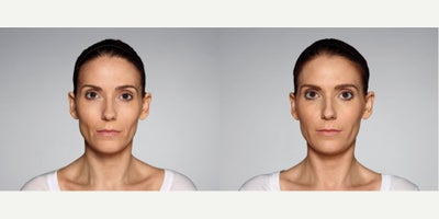 Woman treated with Restylane Defyne - 1.0 mL Restylane Defyne in nasolabial folds1.0 mL Restylane Defyne in marionette linesPhotos taken before treatment and 2 weeks after treatment