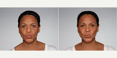 Woman treated with Restylane Defyne - 1.0 mL Restylane Defyne in nasolabial folds1.0 mL Restylane Refyne in marionette lines2.5 mL Restylane Lyft in cheeksPhotos taken before treatment and 2 weeks after treatment