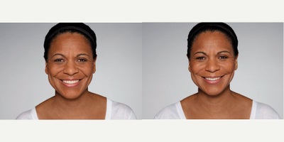 Woman treated with Restylane Defyne - 1.0 mL Restylane Defyne in nasolabial folds1.0 mL Restylane Refyne in marionette lines2.5 mL Restylane Lyft in cheeksPhotos taken before treatment and 2 weeks after treatment
