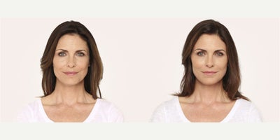 Woman treated with Radiesse - Woman treated with Radiesse