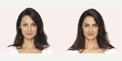 Woman treated with Radiesse - Woman treated with Radiesse