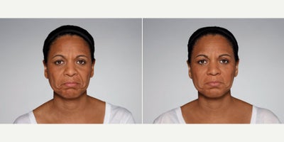 Woman treated with Restylane Defyne - 1.0 mL Restylane Defyne in nasolabial folds1.0 mL Restylane Refyne in marionette lines2.5 mL Restylane Lyft in cheeksPhotos taken before treatment and 2 weeks after treatment