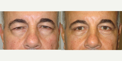 58 year old man treated with Ptosis Surgery - 58 year old male, who underwent bilateral upper internal eyelid ptosis (droopy eyelid) surgery and blepharoplasty.