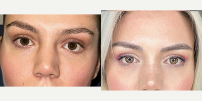 25-34 year old woman treated with Eyelid Retraction Repair - Botched lower eyelid blepharoplasty surgery. Left eye retraction repair with her own tissues from a scarless incission. You can see the natural results...