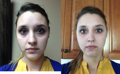 25-34 year old woman treated with Restylane - 1 syringe of Restylane injected into the under eyes to remove dark circles and the tired look.