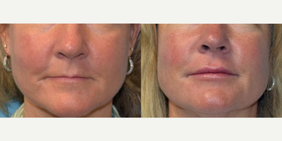 45-54 year old woman treated with Restylane - 45 year old female received 2 syringes of Restylane filler to her lips; photos depict the patient's results 3 months post-op.