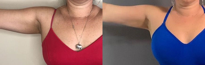 35-44 year old woman treated with i-Lipo - 35-44 year old woman treated with i-Lipo to arms