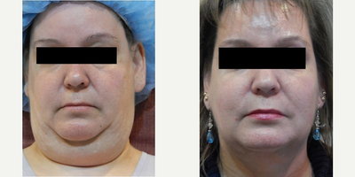 Woman treated with ThermiTight - Smart Lipo on Neck