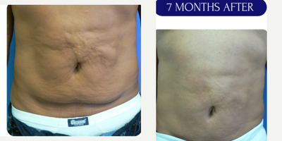 45-54 year old man treated with Lipodissolve - lipodissolve injections