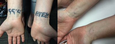 45-54 year old woman treated with Enlighten - Patient received significant clearance of unwanted tattoos following 5 enlighten laser treatments using Describe patch.