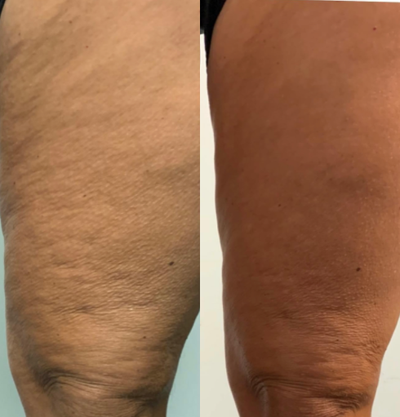 45-54 year old woman treated with Secret RF - Results with the Tempsure Firm to tighten and rejuvenate the skin! These before and after pictures are after four treatments. There is no down time and you can return to your normal activities immediately after. The Tempsure Firm delivers radio frequency energy to gently heat your skin. This will trigger a natural response for your skin to create new collagen.