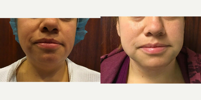 35-44 year old woman treated with Slim Lipo - 39-year-old woman underwent liposuction of the neck.
