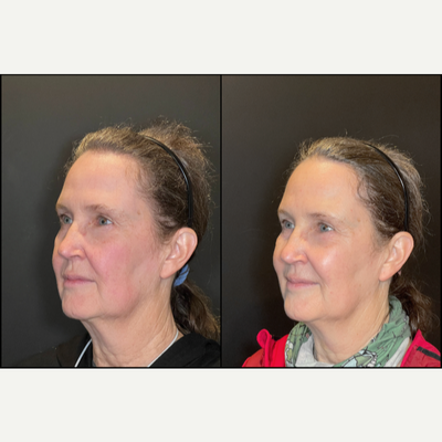 55-64 year old woman treated with BroadBand Light (BBL), Botox for Hyperhidrosis - 1 Month Post Forever Young BBL to Target Redness