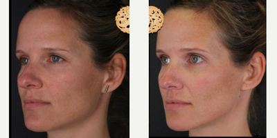 35-44 year old woman treated with Dermalinfusion - Dermal Infusion - Before & After